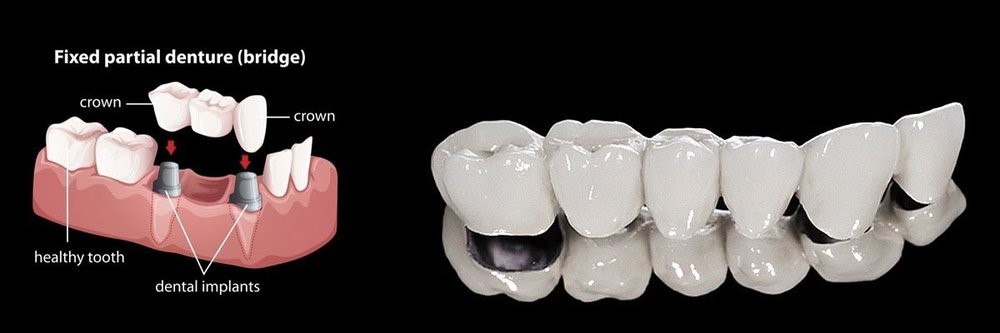 Partial Dentures Procedure Henderson KY 42420